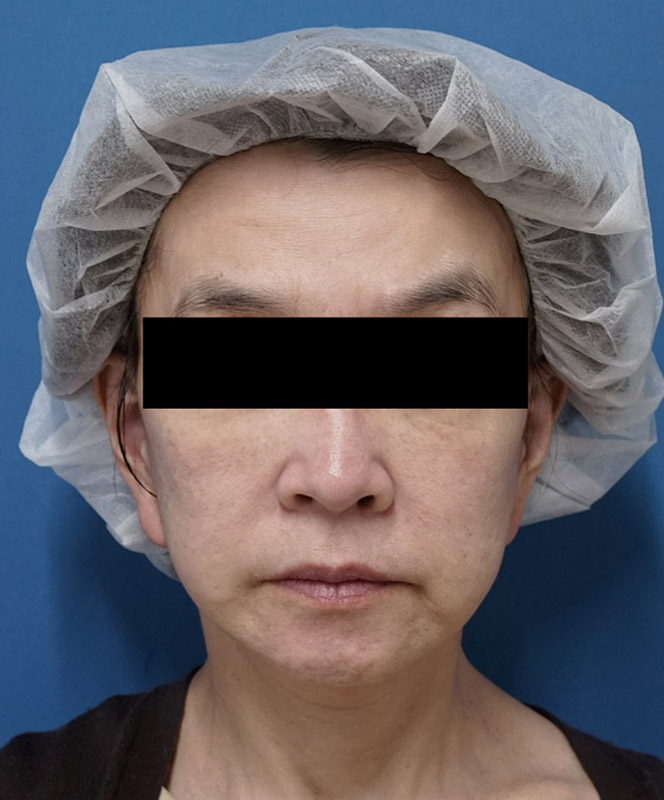 ミントリフトミニ 1週間後のBefore写真