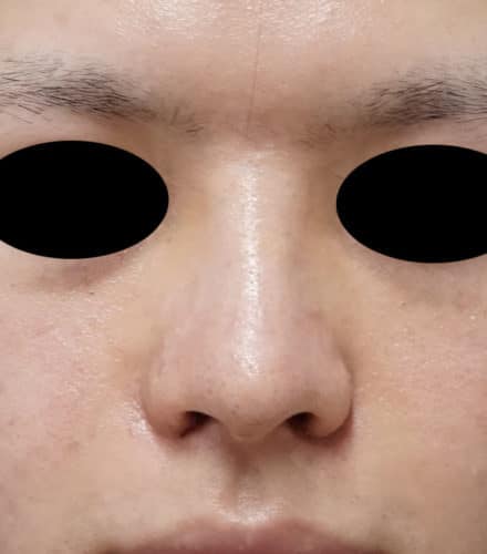 小鼻縮小（内側法、フラップ法）、Ｉ型鼻根プロテーゼ　１週間後のAfter写真