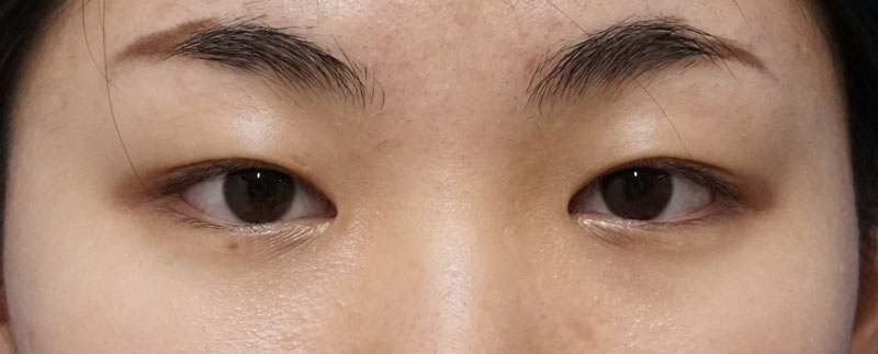 切らない眼瞼下垂 プレミアム　3か月後のBefore写真