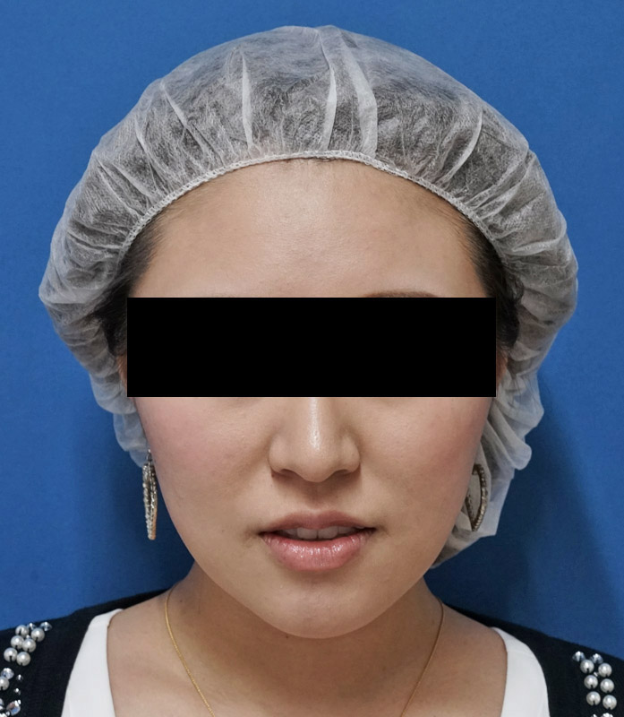 ミントリフトミニ　1ヶ月後、直後ものAfter写真