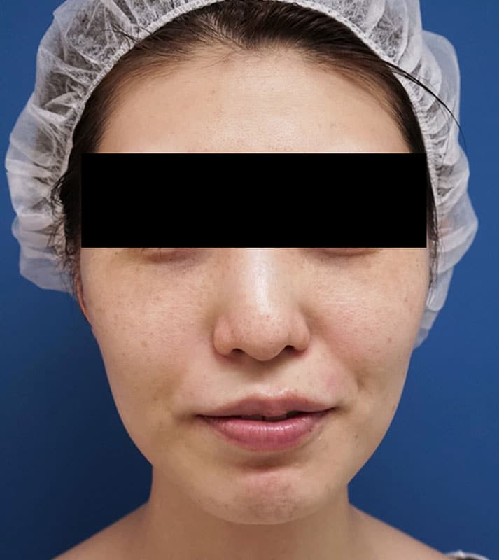 鼻尖縮小＋軟骨移植＋ストラット、鼻翼縮小（内＋外）　３ヶ月後　正面のBefore写真