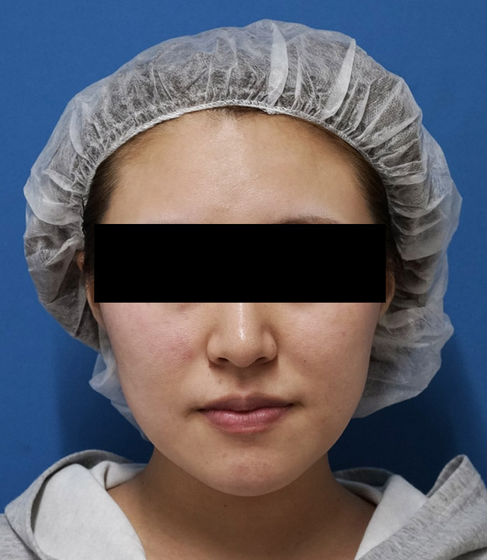 鼻尖縮小＋軟骨移植＋ストラット、鼻翼縮小（内＋外）　３ヶ月後　正面のBefore写真