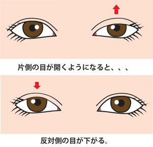 片目の眼瞼下垂が改善するともう片方が下がる（へリングの法則）