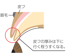 二重左右差 まぶた断面図