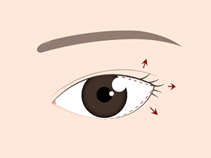 目尻切開の効果