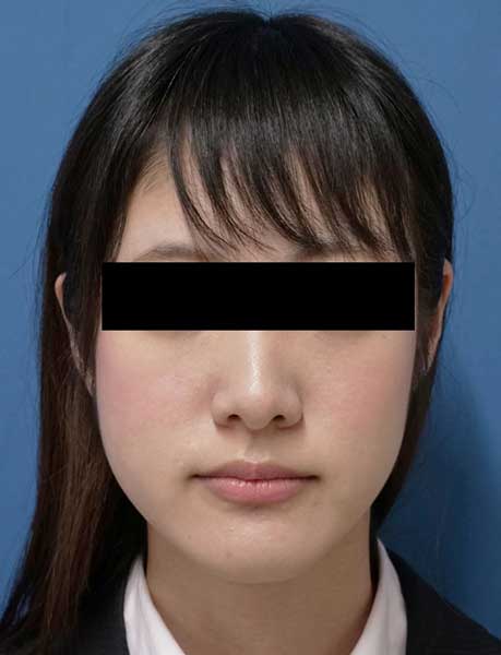 BNLS12cc（法令線上、ホホ、フェイスライン下）2回終了後のBefore写真