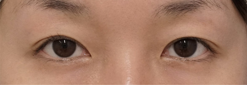 もとびアイプラチナム　1ヶ月後のAfterの写真