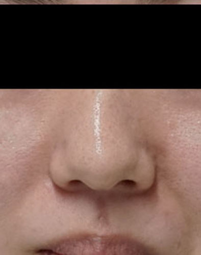鼻尖形成（３D法）　施術前　正面