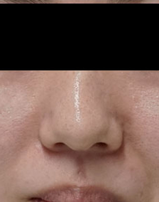 鼻尖形成（３D法）　半年後のBefore写真