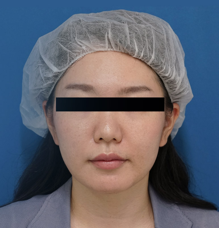 小顔脂肪吸引（ホホ・アゴ下・法令線上)＋アラガン強力小顔ボトックス　1ヶ月後のAfterの写真