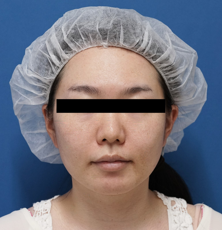 小顔脂肪吸引（ホホ・アゴ下・法令線上)＋アラガン強力小顔ボトックス　1ヶ月後のBefore写真