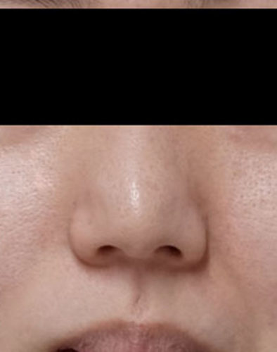 鼻尖形成（３D法）　施術前　半年後