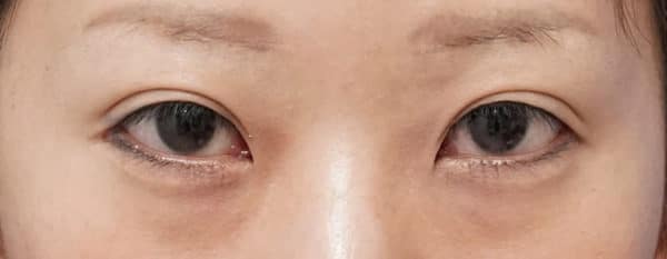 目尻切開、目頭切開（リドレープ法）控えめ希望　3ヶ月後のAfterの写真