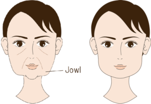 HIFU　ハイフ　jowlと下膨れ