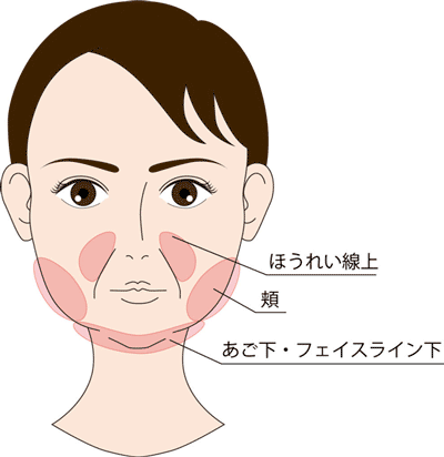 HIFU-皮下脂肪がつきやすい部分