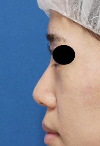 鼻I型プロテーゼ、鼻尖形成(3D法)、軟骨移植　手術前　左側面