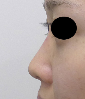 鼻プロテーゼ　手術前　左側面