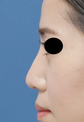 鼻I型プロテーゼ、鼻尖形成(3D法)、軟骨移植　3ヶ月後　左側面