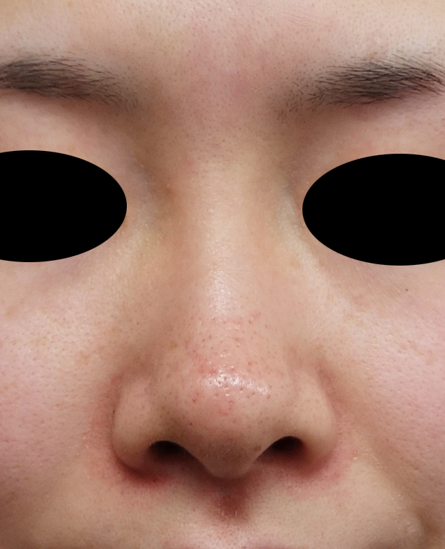 鼻中隔延長、鼻尖形成、I型プロテーゼ　3ヶ月後のBefore写真