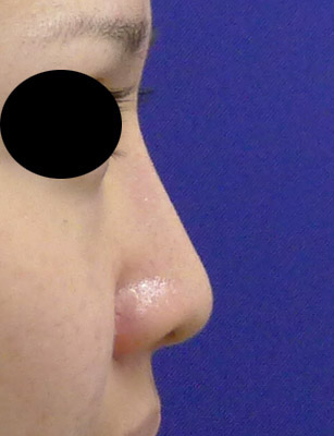鼻プロテーゼ　3ヶ月後　右側面