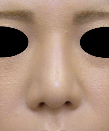 鼻尖形成（３D法）、プロテーゼ　3ヶ月後　正面