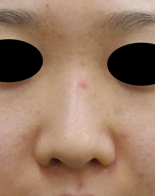 鼻プロテーゼ　3ヶ月後のBefore写真
