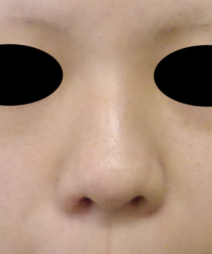 鼻尖形成（３D法）、プロテーゼ　手術前　正面