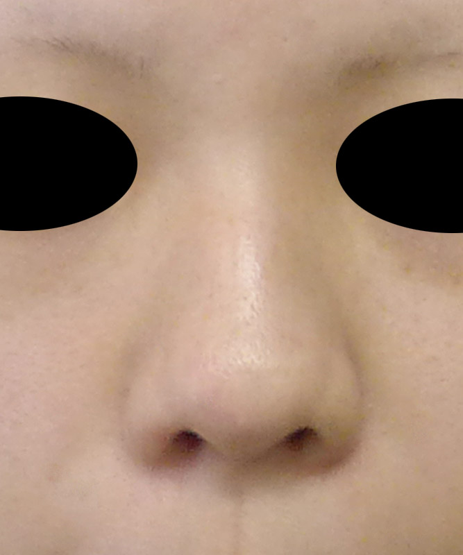 鼻尖形成（３D法）、プロテーゼのBefore写真