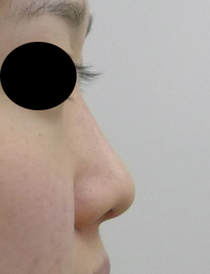 鼻プロテーゼ　手術前　右側面