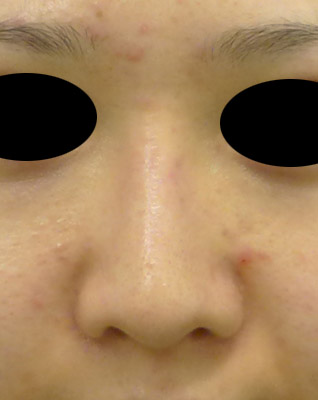 鼻プロテーゼ　3ヶ月後のAfterの写真