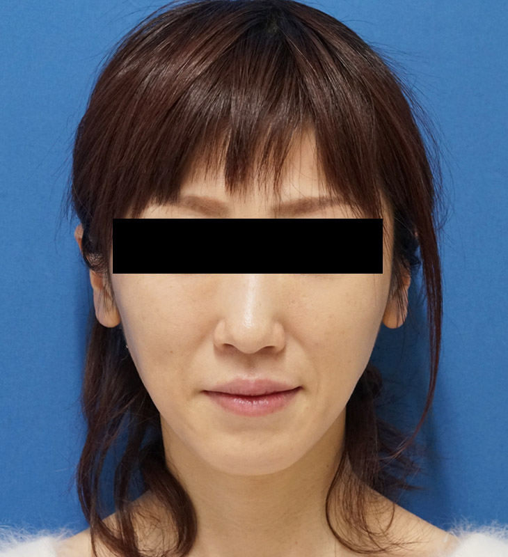 バッカルファット 1ヶ月後のAfterの写真