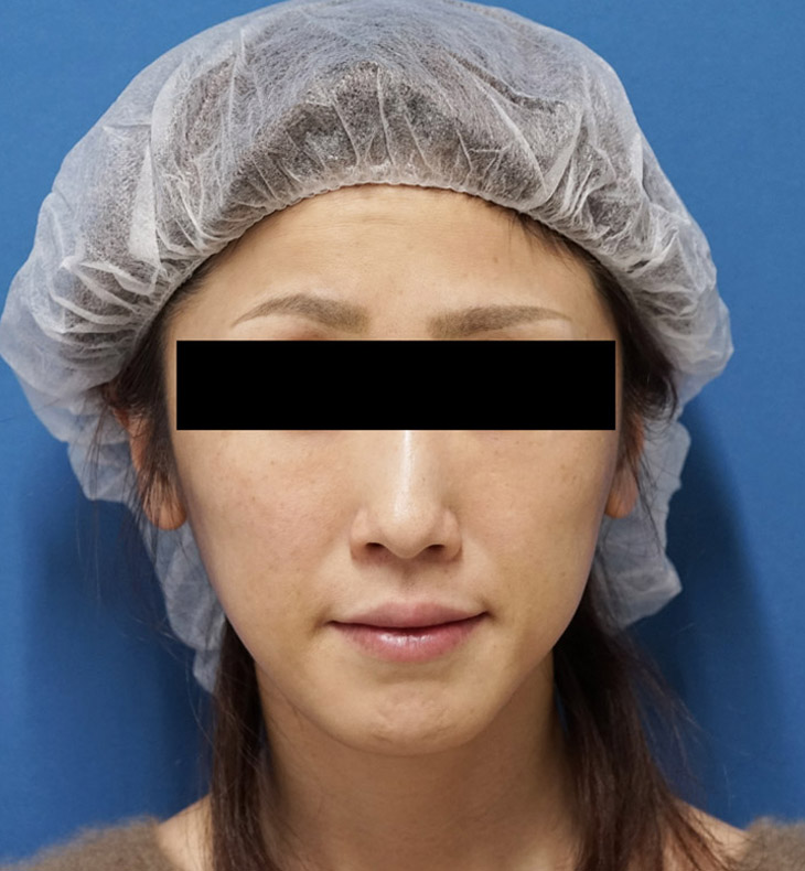 バッカルファット 1ヶ月後のBefore写真