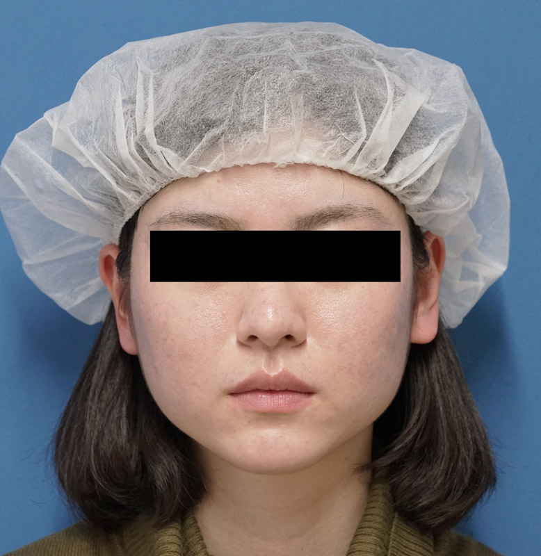 小顔脂肪吸引(ホホ・ほうれい線上・アゴ下)、アラガン超強力小顔ボトックス　1ヶ月後のBefore写真