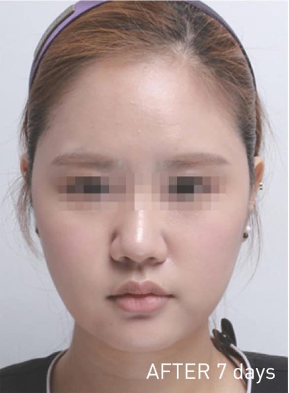 BNLS neoのAfter写真