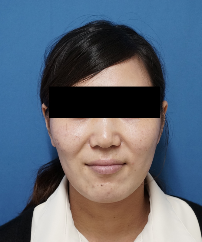 鼻尖縮小＋軟骨移植＋ストラット、鼻翼縮小（内＋外）　３ヶ月後　正面のBefore写真