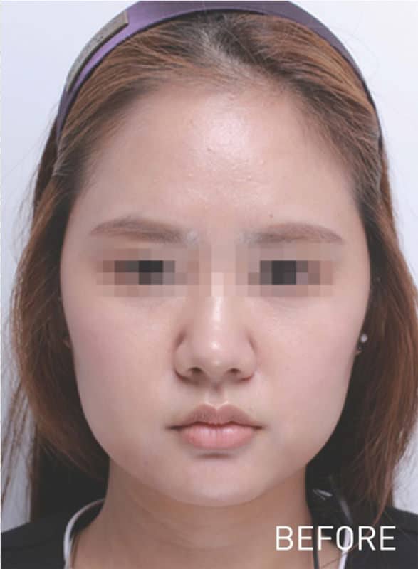 鼻尖縮小＋軟骨移植＋ストラット、鼻翼縮小（内＋外）　３ヶ月後　正面のBefore写真