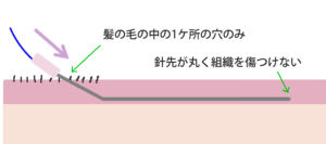 ミントリフトミニ挿入方法