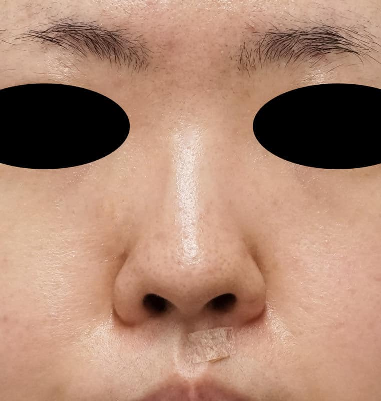 鼻尖縮小（３D法）、軟骨移植　半年後のBefore写真