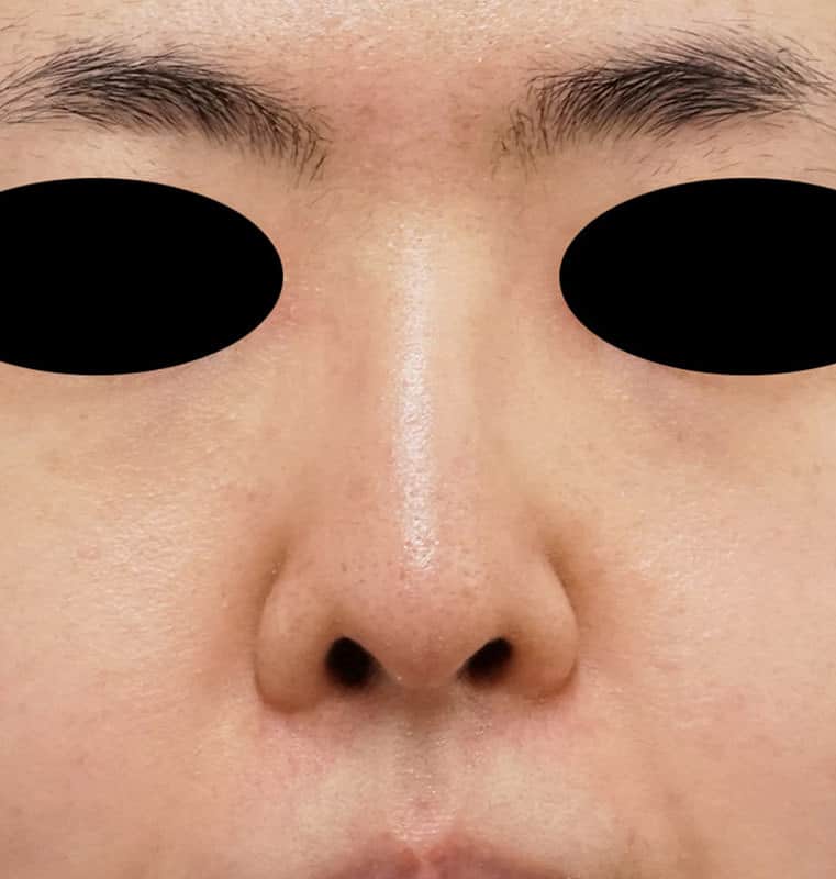鼻尖縮小（３D法）、軟骨移植　半年後のAfterの写真
