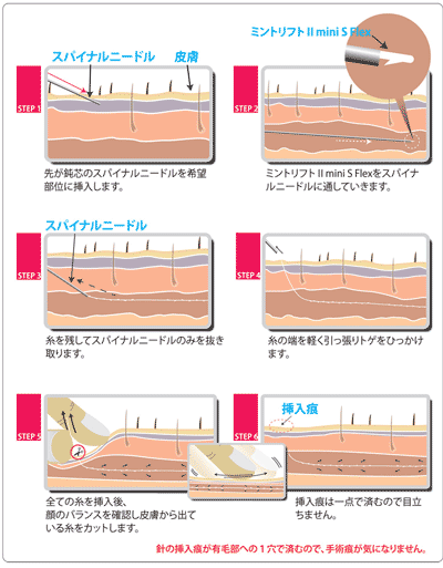 ミントリフトミニ　施術方法