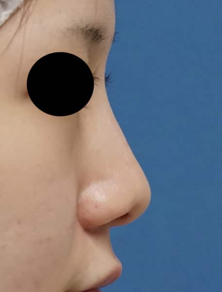 鼻尖縮小、鼻尖軟骨移植　1か月後のBefore写真