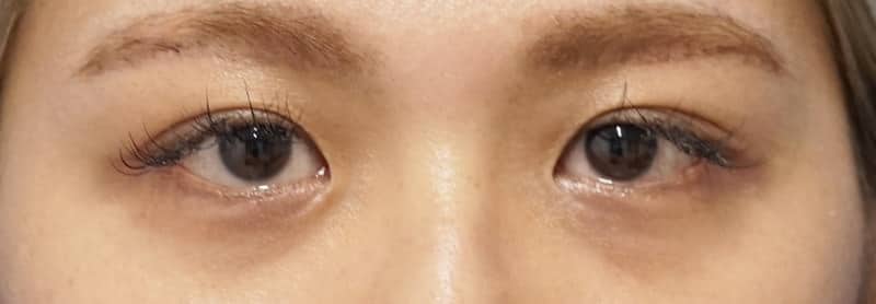 鼻尖縮小＋軟骨移植＋ストラット、鼻翼縮小（内＋外）　３ヶ月後　正面のBefore写真