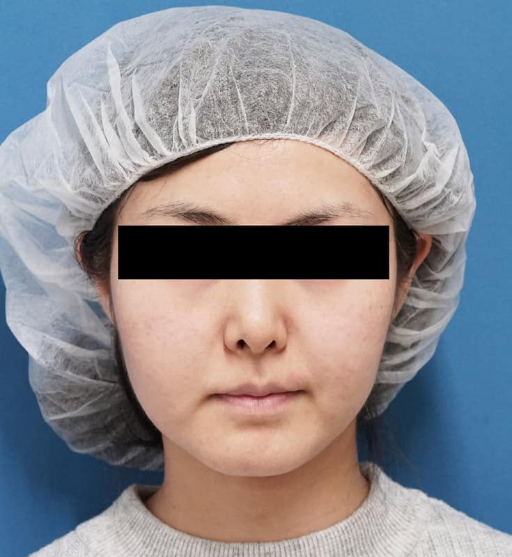 バッカルファット除去　3ヶ月後のBefore写真