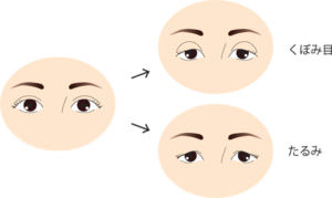 二重の人の加齢による変化の図