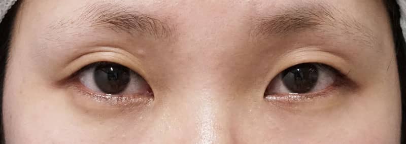 もとびアイゴールド 手術前~3ヶ月後の経過のBefore写真