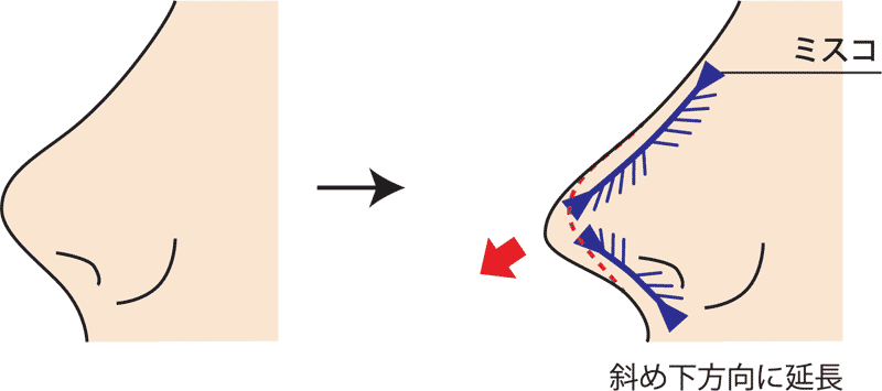 MISKOミスコ斜め下方向に糸挿入図