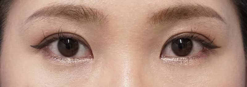 もとびアイゴールド 手術前~3ヶ月後の経過のAfterの写真
