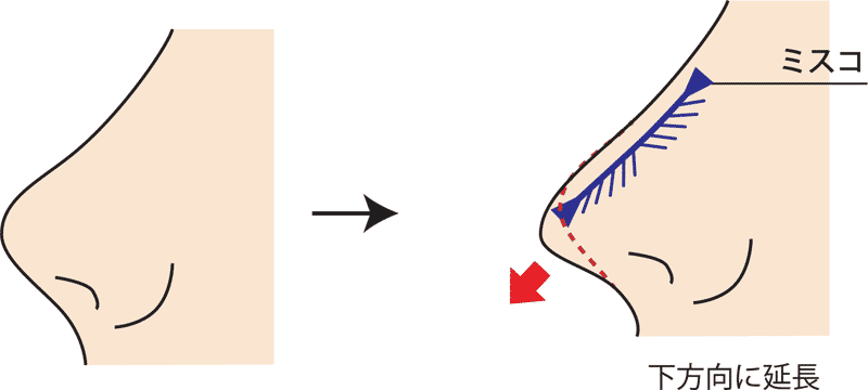 MISKOミスコ下方向に糸挿入図