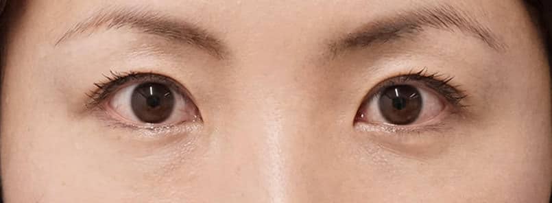 もとびアイプラチナム 1ヶ月後、3ヶ月後のAfterの写真