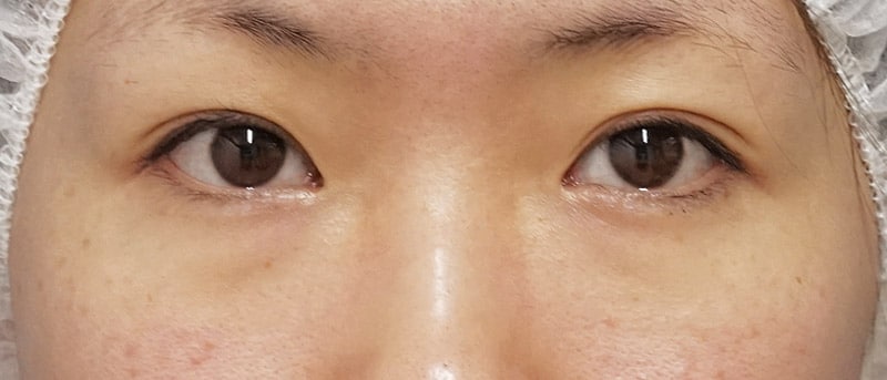 目の下脂肪取り+コンデンス脂肪注入 3ヶ月後のBefore写真